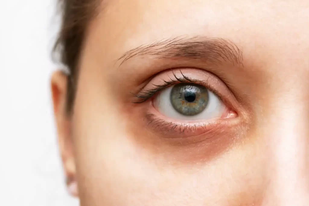 Laser treatments for eyebag