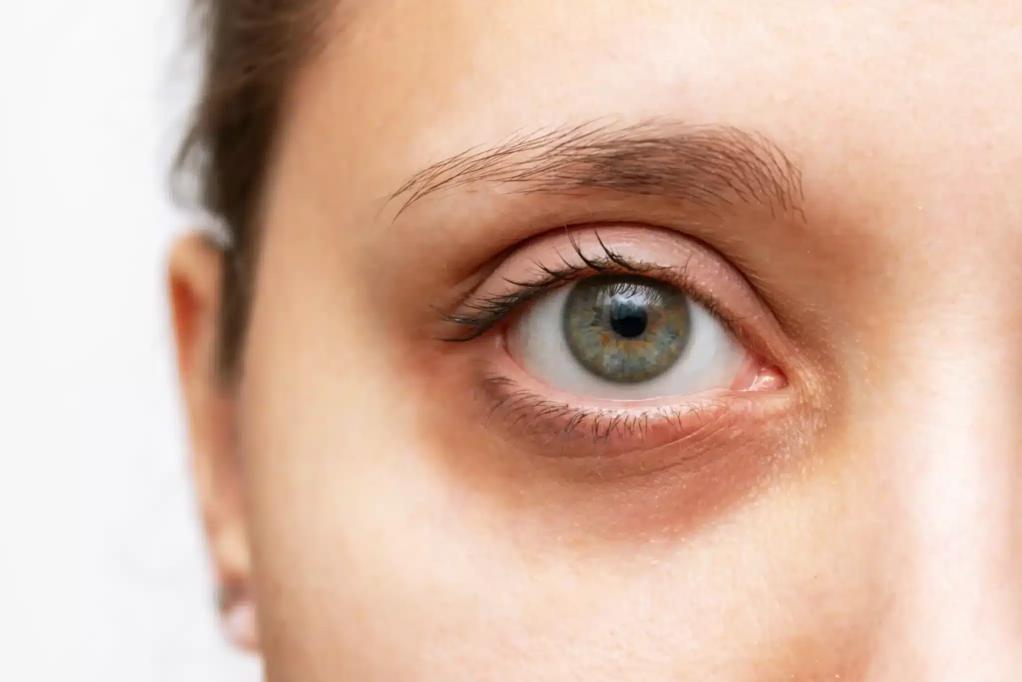 Laser treatments for eyebag